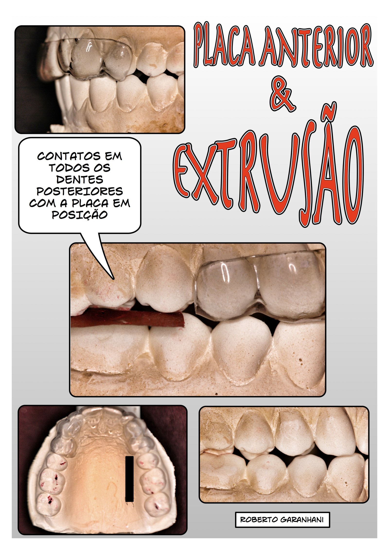 Se estudos mostram semelhanças nos benefícios entre os dispositivos oclusais, que tal selecioná-los avaliando os riscos que estes podem oferecer?
