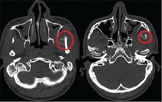 joralmaxillofacpathol_2014_18_2_271_140781_u5